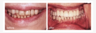 Shot Of Before And After Visiting Abington Smile Gallery - Aggression