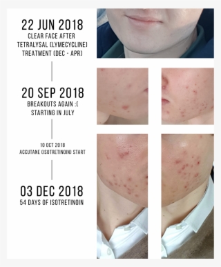 Acne[acne] From Clear Face To Horror - Scar