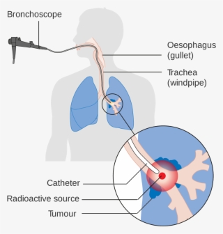 Lung Cancer Is The Leading Cause Of Death Due To Cancer - Lung Cancer Radiation Therapy Diagram