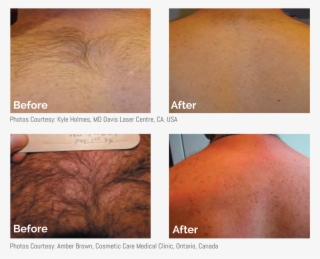 Before & After Mens Laser Hair Removal Back And Shoulders - Laser Hair Reduction Men