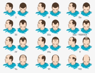 Male Pattern Baldness - Team