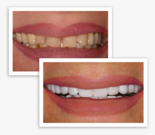 Smile Before And After Treatment - Lip Gloss