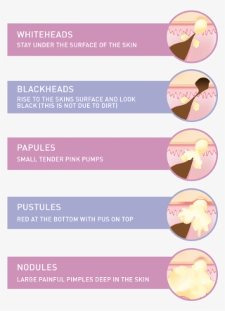 Types Of Acne Infographic - Beige