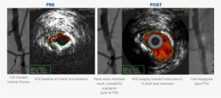 Outstanding Luminal Gain In Calcified, Eccentric Common - Atherectomy Ultrasound
