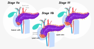 Illustration Of Stage Iia, Iib, And Stage Iii Pancreatic - 4 Pancreatic Cancer Stages That Help You