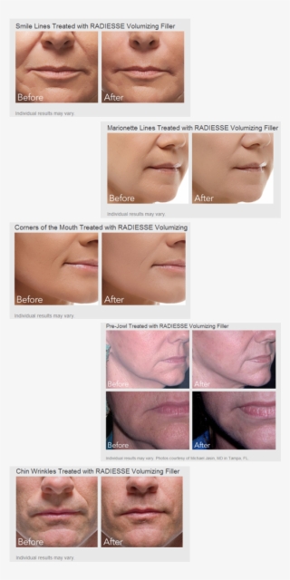 Radiesse® Wrinkle Filler Does More Than Just “fill-in” - Radiesse Before And After