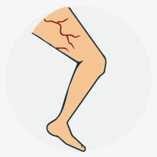 Varicose Vein - Illustration