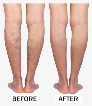 varicose veins before & after - sclerotherapy before and after