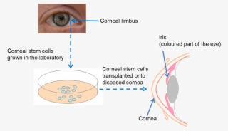 Diagram On Repairing The Cornea - Stem Cell In Eye