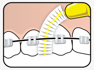 Tepe Interdental Brush™ On Braces - Diagram