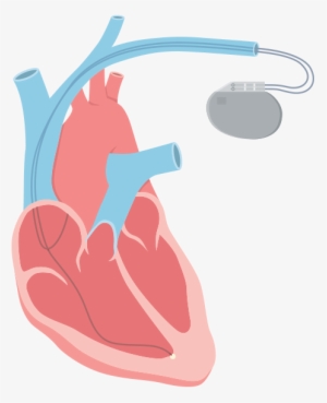 An Irregular Heart Rhythm That Is Too Slow, Usually - Artificial Cardiac Pacemaker