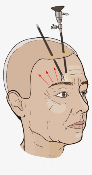 Diagram Of Endoscopic Brow Lift To Raise The Forehead - Illustration