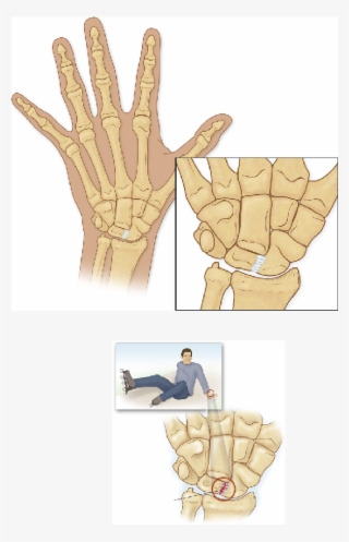 Carpal Tunnel Syndrome Causes, Symptoms, & Treatment - Carpal Tunnel  Syndrome Transparent PNG - 1000x652 - Free Download on NicePNG