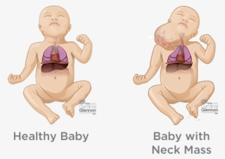 Fetal Neck Masses - Fetal Teratoma Neck