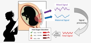 We Are Developing A Non-invasive, Transabdominal Fetal - Diagram
