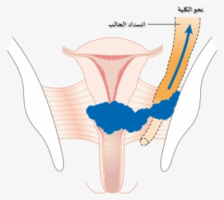 Diagram Showing Stage 3b Cervical Cancer Cruk 226-ar - Stage 3 Cervical Cancer