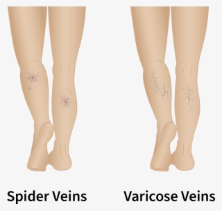 Distinguishing Spider Veins From Varicose Veins - Tights