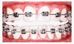 Why Is America Obsessed With Perfect Teeth Science - Braces For Teeth
