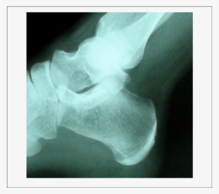 Radiograph Before Shock Wave Therapy - Radiography