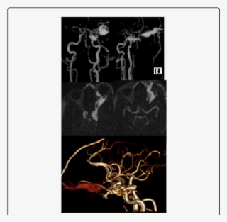 Coronal, Oblique And Axial Postcontrast Mip Images - Skull