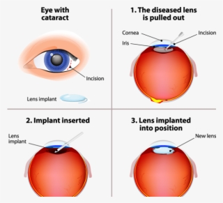 Cataracts Are One Of The Main Causes Of Blindness And - Cataract Surgery