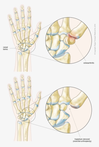 Base Of Thumb Osteoarthritis - Circle