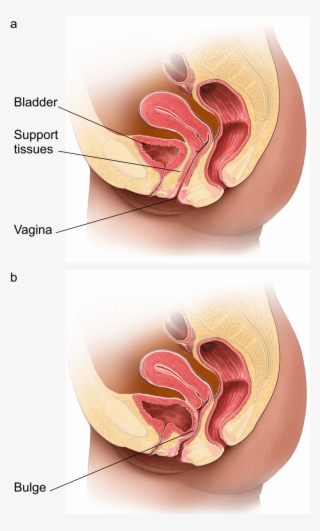 Illustration Showing A Normal Vagina Compared To One - Prolapse Back Vaginal Wall