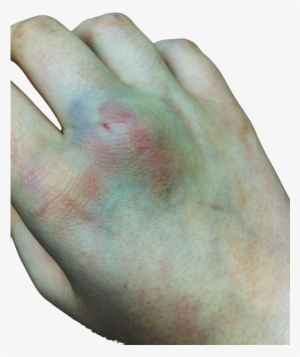 bruise transparent tumblr - blood