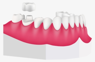 dental crowns at toothbeary