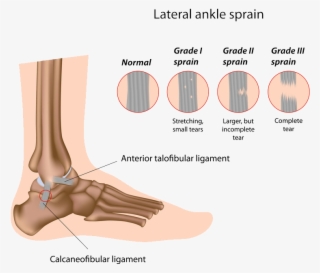 Surgical Options - Sprained Ankle Grade 2