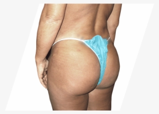 After Brazilian Butt Lift - Brazilian Buttocks