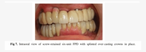 Intraoral View Of Six Unit Screw Retained Fpd Without - Science