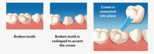 Crowns - Crown Placement On Tooth