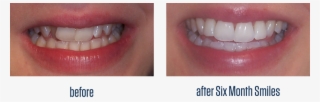 What Is 6 Month Smile® - Tooth Bleaching